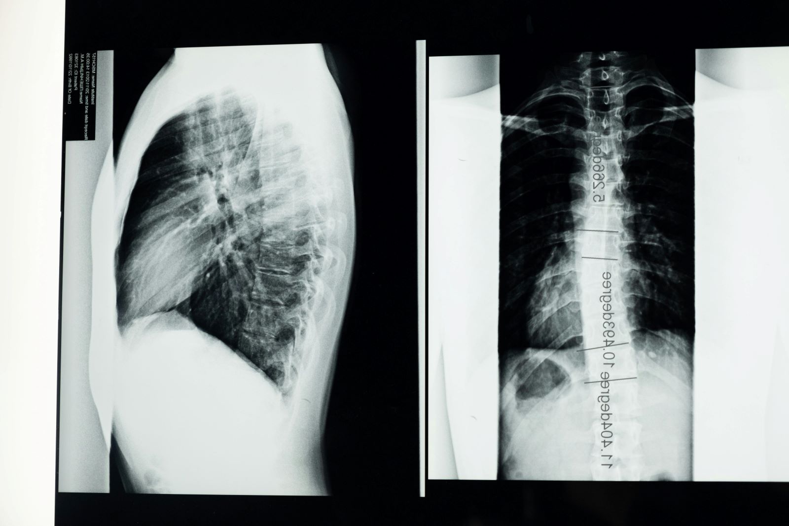 Osteofity - przyczyny objawy leczenie